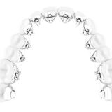 ortodonzia invisibile, apparecchio linguale